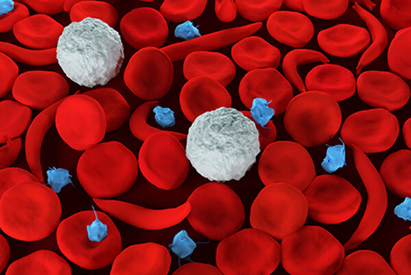 Get Best Aplastic Anemia Treatment in Homeopathy