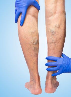 Varicocele Treatment in Hyderabad: Symptoms, Causes, and Care Options