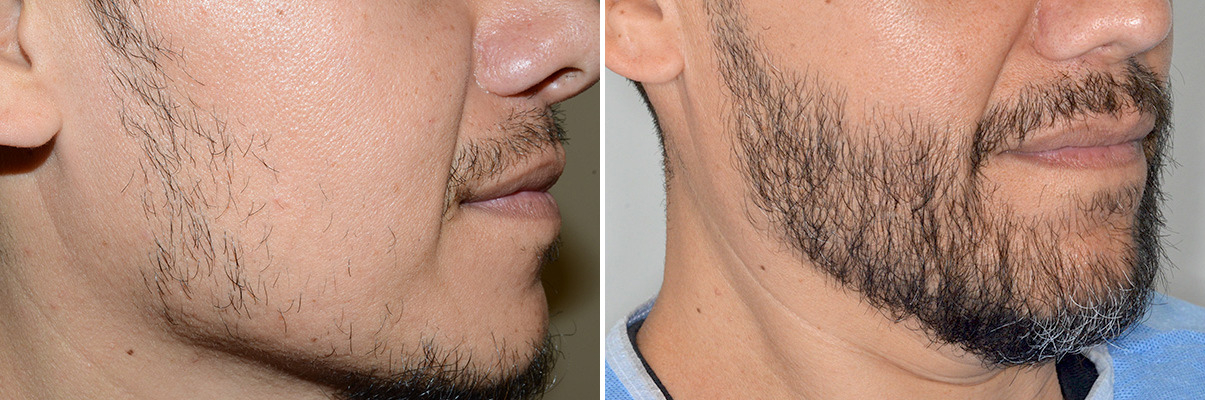 Affordable Options for Beard Hair Transplant in Islamabad