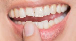 Chipped Crown Tooth: What You Should Do Next